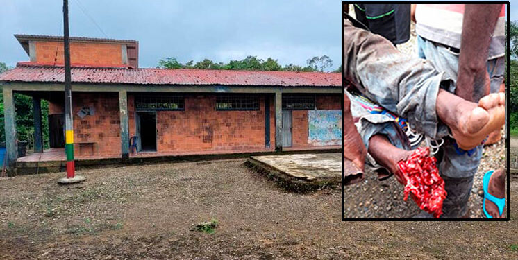 Bajo Baudó: otro chocoano mutilado por un artefacto explosivo en Mochadó