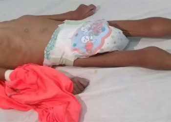 Desnutrición infantil en el Chhocó. Archivo