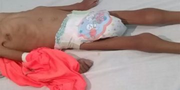 Desnutrición infantil en el Chhocó. Archivo