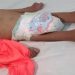 Desnutrición infantil en el Chhocó. Archivo