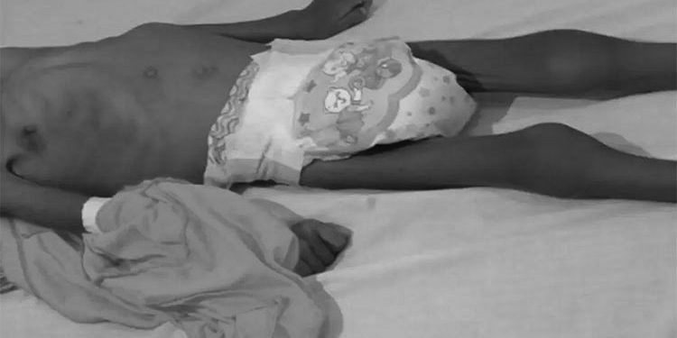 Chocó: aumentan los niños muertos por desnutrición