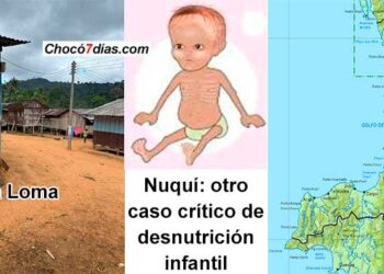 Nuquí, Chocó: otro caso crítico de desnutrición infantil