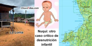 Nuquí, Chocó: otro caso crítico de desnutrición infantil